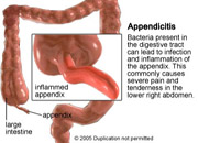 Very official-looking picture of appendicitis, except that 'inflamed' is misspelled